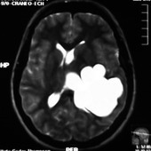 MRI Cerebro