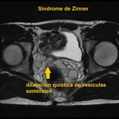 MRI Pelvis